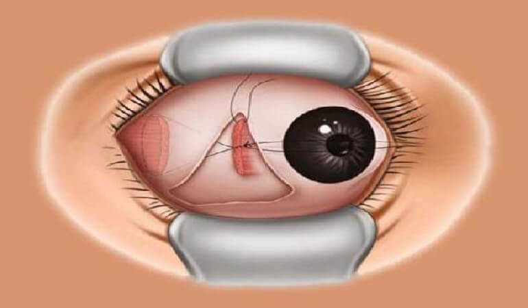 squint eye surgery